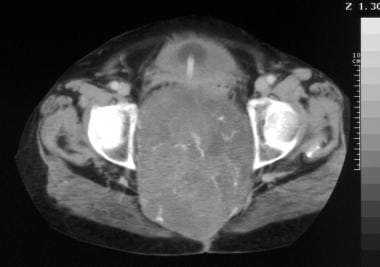 Computed tomography scan. Note the calcification. 