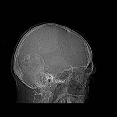 Lateral scout radiograph shows a large densely cal