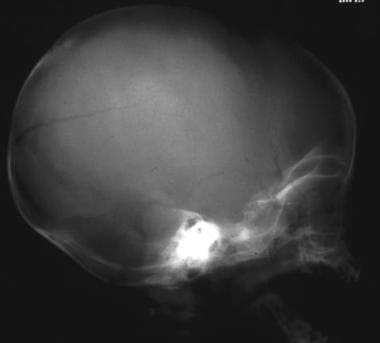 Lateral skull radiograph in a child shows a long, 