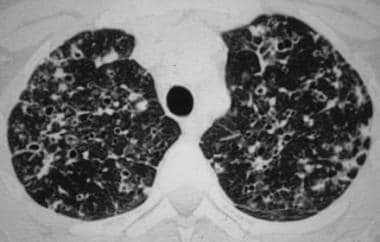 High-resolution chest CT scan in a patient with pu