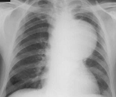 Differential diagnosis. Posteroanterior chest radi