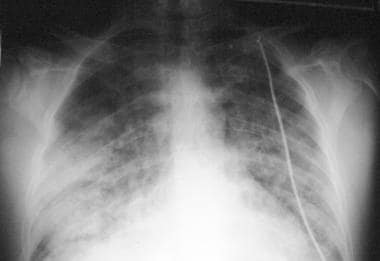 Anteroposterior chest radiograph shows bilateral a