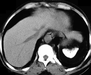 Noncontrast CT scan in a 47-year-old man with sick