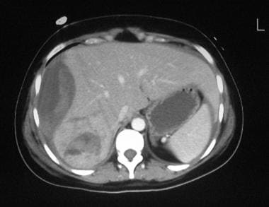 Grade 3 liver injury in a 22-year-old woman after 