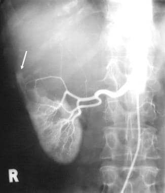 Selective renal arteriogram in a patient with auto