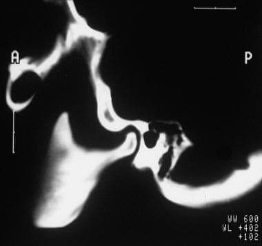 Sagittal CT cut through the temporomandibular join