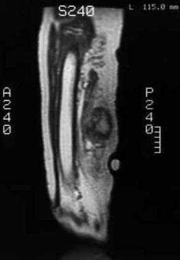 T1-weighted MRI obtained following intravenous gad
