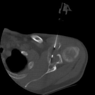 Axial computed tomography (CT) scan through the le