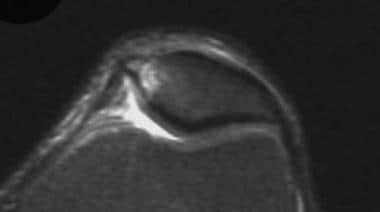 Magnetic resonance image following a patellar disl