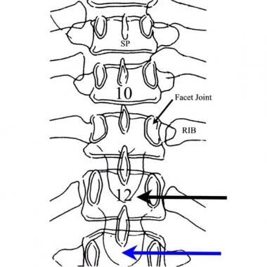 Thoracic spine trauma. Posterior drawing of the lo