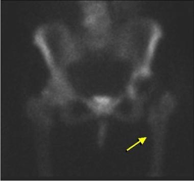 Bone scan from an asymptomatic patient following a