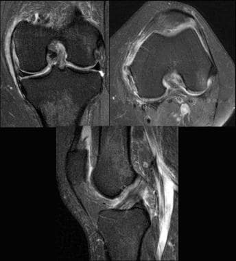 Partial ACL tear (arthroscopically proven). Images