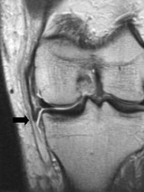 Acute grade III tear with a folded ligament (arrow