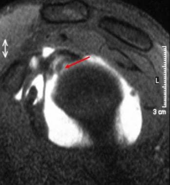 Labral tear. Sagittal view showing a superior labr