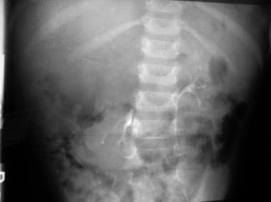 An intravenous pyelogram (IVP) shows an inferiorly