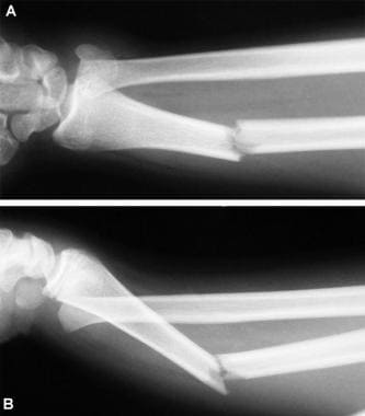 Pseudo-Galeazzi fracture. Anteroposterior (A) and 