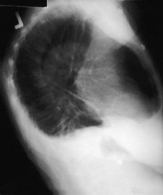Chest radiograph, lateral view shows loss of bilat