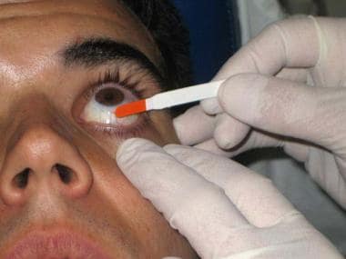 Instilling fluorescein onto the cornea. 