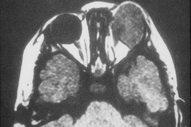 Axial CT scan of left orbital rhabdomyosarcoma. Im