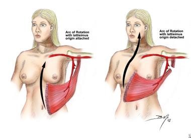 Harvest and arc of rotation of the latissimus dors