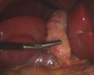 Laparoscopic cholecystectomy. Medial grasper is ap