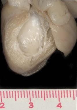 心内膜弹力纤维增生症：大体解剖。图像C