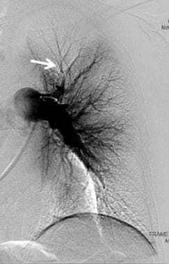 Selective left pulmonary angiogram shows abrupt ta