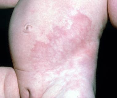 Similar lesions are seen on the abdominal skin of 