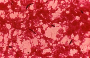 Photomicrograph of gram-positive organisms in acti