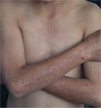 Photodistribution of lesions over the body. Note t