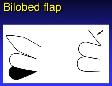 Bilobed flap. 