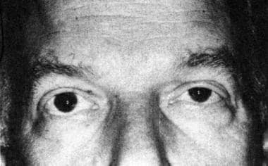 Evident in this patient are the mild ptosis of the