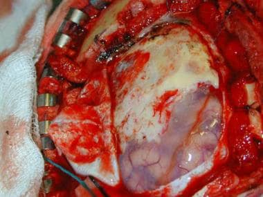 Case 1: Surgical view of the tumor. The dura is op