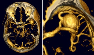 Cerebral aneurysms. CT angiography of a right midd