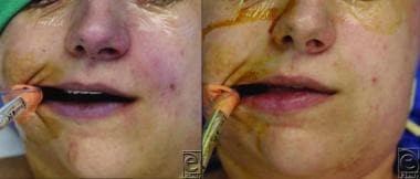 Cyanosis. Left: Facial cyanosis in a patient with 