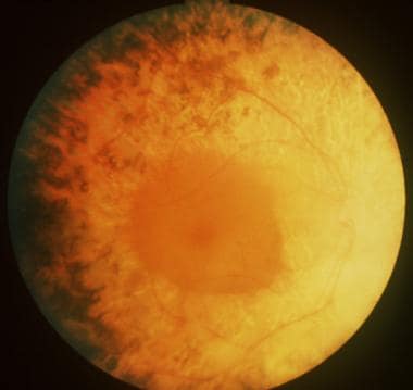 Usher syndrome with typical retinitis pigmentosa a