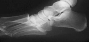 Preoperative lateral radiograph demonstrates a Lis