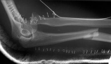 Unsuccessful open reduction of Monteggia fracture-