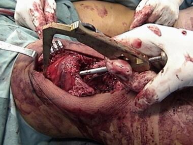 Patellar tendon rupture. An anterior cruciate liga