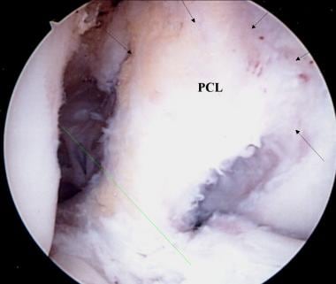 A view of the broad origin of the posterior crucia