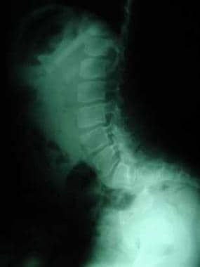 Lumbar lordosis in a patient with diastrophic dysp