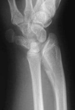 Preoperative anteroposterior radiograph of wrist o