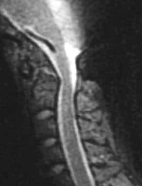 T2-weighted parasagittal MRI image of a patient wi