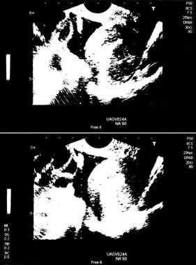 Ultrasonographic presentation of ovarian hyperstim