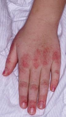 dermatomyositis children