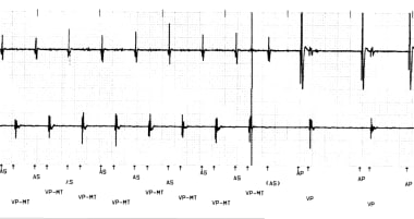 This is a typical example of PMT with ventricular 