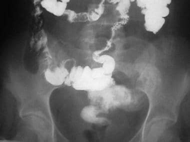 炎症性肠病。Enteroenteric瘘