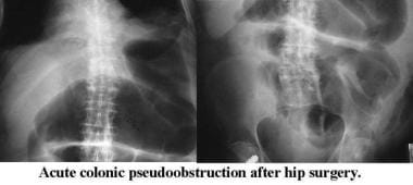 Abdominal radiographs confirm acute colonic pseudo