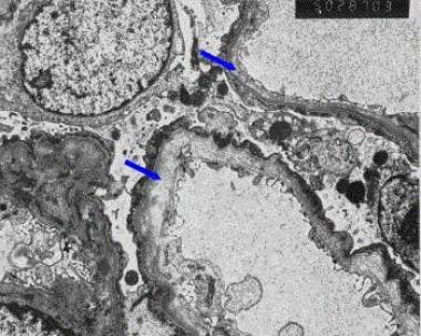 Electron micrograph of a kidney biopsy from a pati