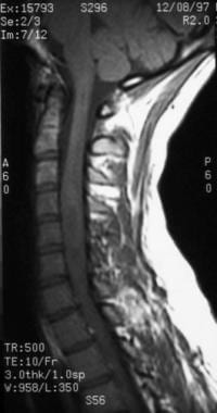 This T1-weighted sagittal MRI is from a 19-year-ol
